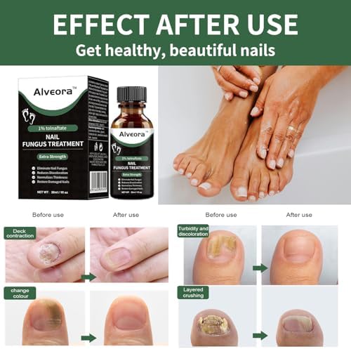 Applying Alveora antifungal liquid to thick toenail using precision brush