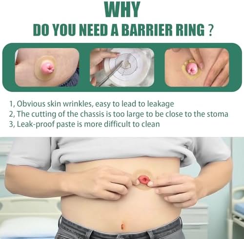 XIIFIIFII cohesive stoma rings demonstrating how the hydrocolloid material stretches for a custom leakproof fit.