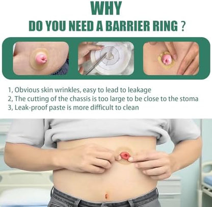 XIIFIIFII cohesive stoma rings demonstrating how the hydrocolloid material stretches for a custom leakproof fit.