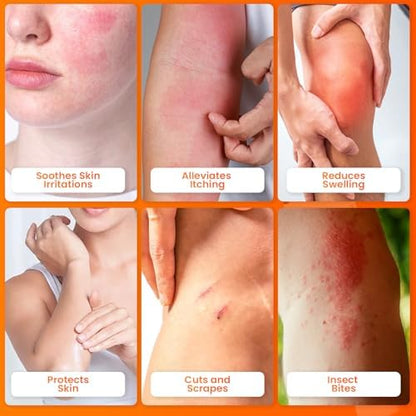 AVEDANA topical steroid treatment for insect bites and poison ivy.