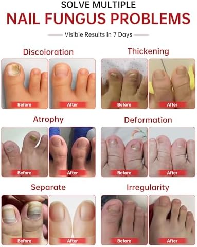 QQE 25 percent Undecylenic Acid liquid dropper showing clear solution for yellow nails.