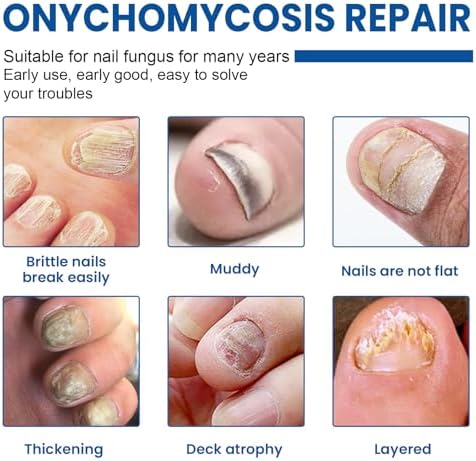 Overnight toenail fungus treatment patch applied to a toe.
