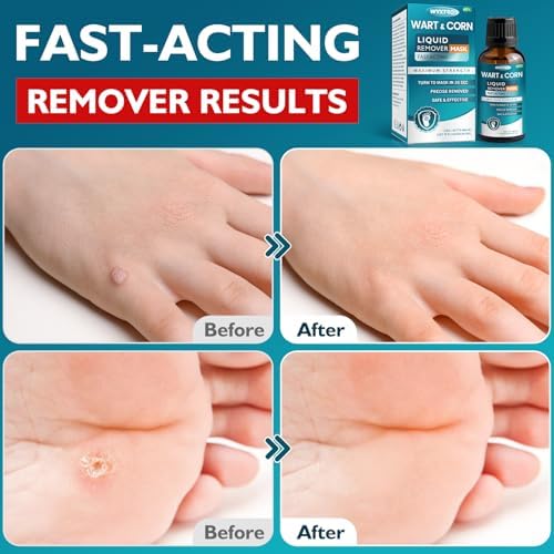 Authentic USA imported WYXTRO wart removal liquid for Indian consumers.