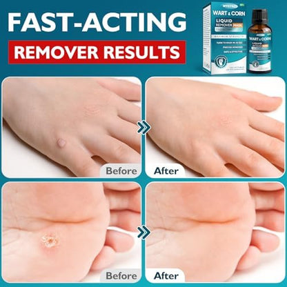 Authentic USA imported WYXTRO wart removal liquid for Indian consumers.