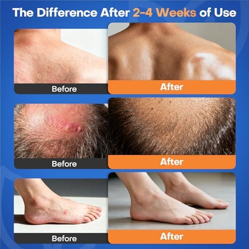 Side view of Seebeellar antifungal cream detailing instructions for seborrheic dermatitis.