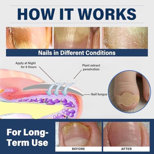 Hydrogel nail patches for treating discolored and damaged fingernails.