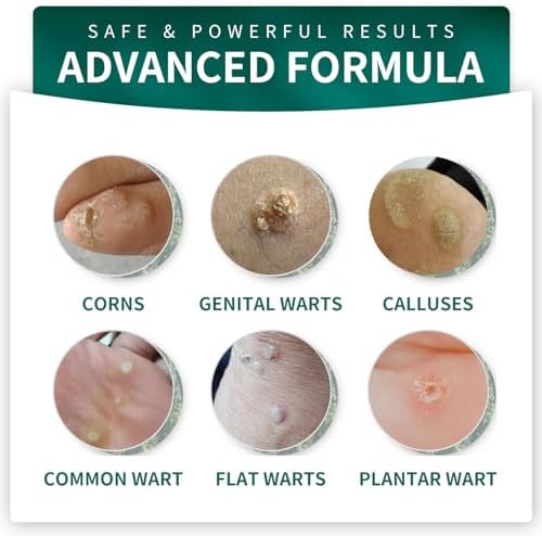 ELEFOCUS fast acting wart freeze off liquid for plantar and common wart relief.