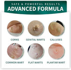 ELEFOCUS fast acting wart freeze off liquid for plantar and common wart relief.