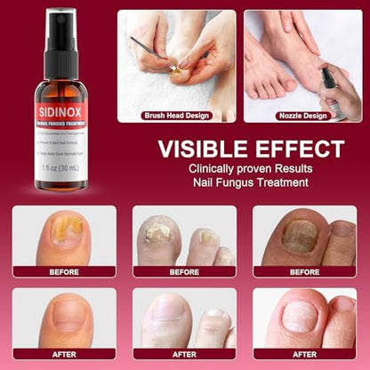 Close up of Sidinox maximum strength fungal nail treatment packaging