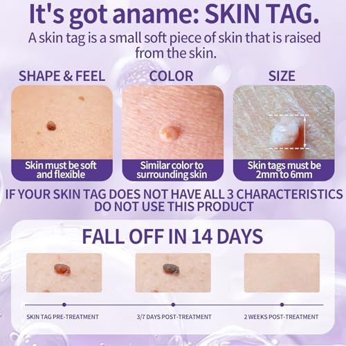 Imported USA skin tag remover kit with precision applicator
