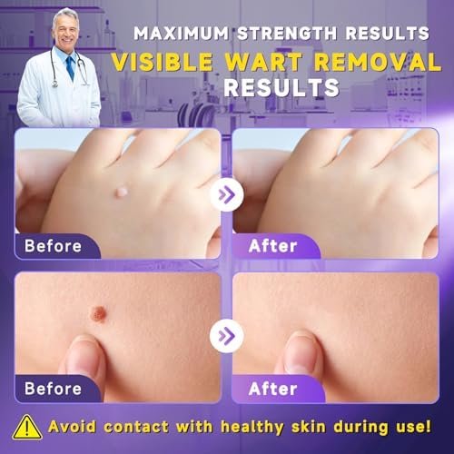 TTsiya 17 percent salicylic acid formula for corn and callus removal