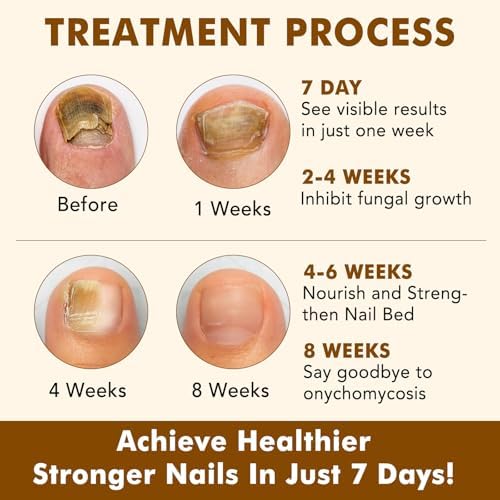 Applying cuticle care oil to dry nails and cuticles