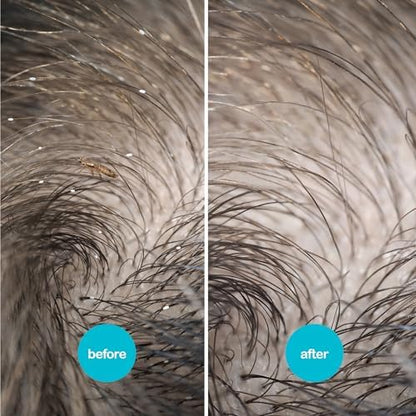 Close up of NitWits packaging highlighting the pesticide free and kills super lice claims.