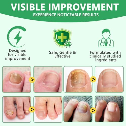 Benefits of Xinszlin ginger nail oil for damaged nails