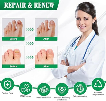 Dermfree antifungal pen being applied to a damaged toenail for fungus removal.