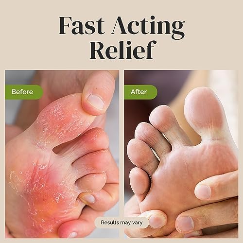 Puriya Tea Tree Oil skin balm texture and consistency for athlete foot application