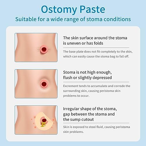 Ovand stoma adhesive skin barrier paste leak resistant seal guide