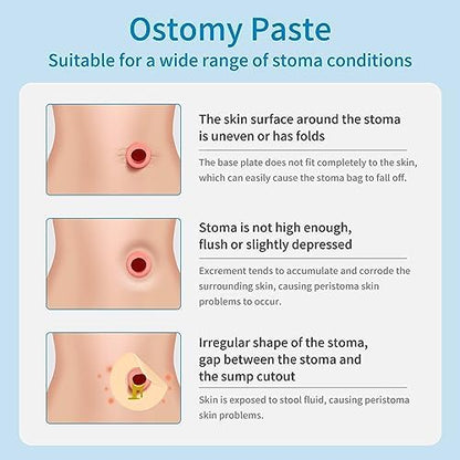 Ovand stoma adhesive skin barrier paste leak resistant seal guide