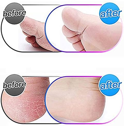 Washable replacement heads for Amope Pedi Perfect compatible with hard skin removal