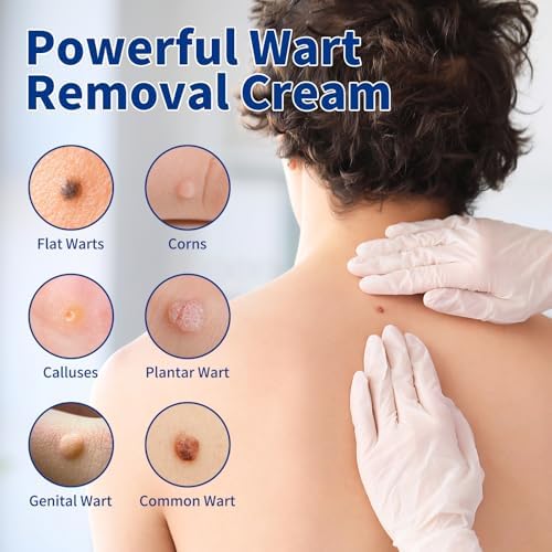 Maximum strength 17 percent salicylic acid wart remover ointment tubes.