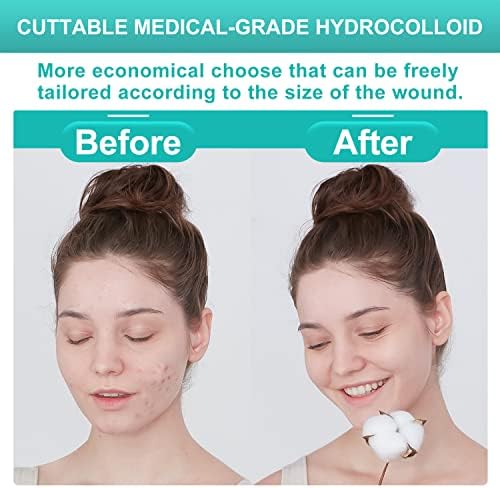 Dimora large gel forming acne pad being removed from its sterile individual packaging