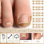Full layout of the sixteen piece home pedicure set highlighting the multiple styles of corrective alignment stickers