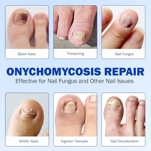 Kit of 21 pieces nail treatment patches for ingrown toenail correction.