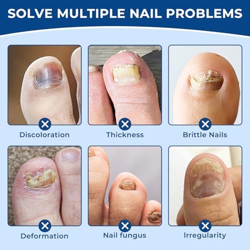 Close up of adhesive antifungal patch for discolored and thick toenails