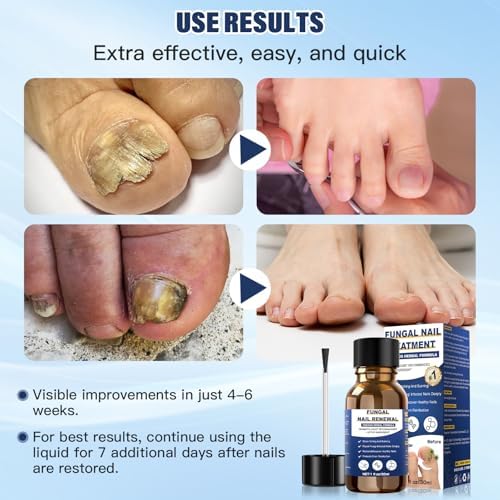 Authentic USA imported Sechkiss treatment for onychomycosis and nail health.