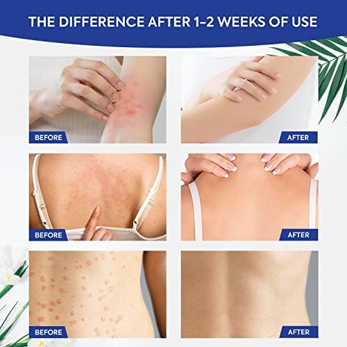 Charmpoo imported USA skincare formula showing application directions for body fungus