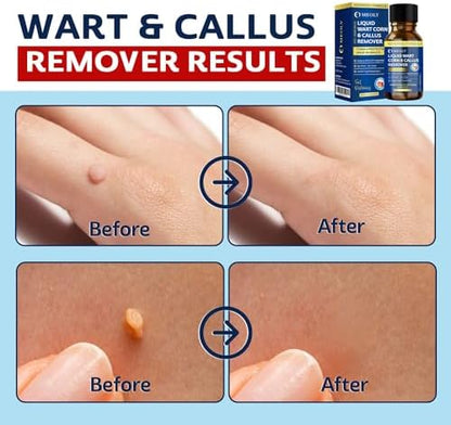 Close up of applicator for MEOLY fast acting wart and flat wart treatment