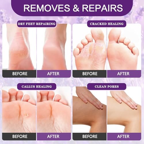 Before and after visualization of smooth heels after using the XIWEIOO callus remover system.
