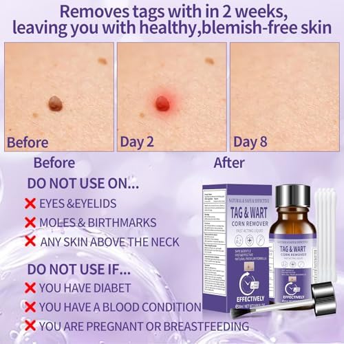 Skin tag removal solution with herbal extracts for sensitive skin