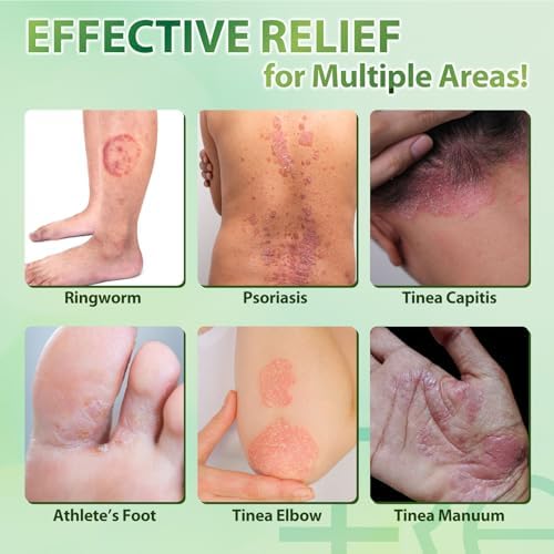 Antifungal skin treatment for men and women showing the natural botanical components.