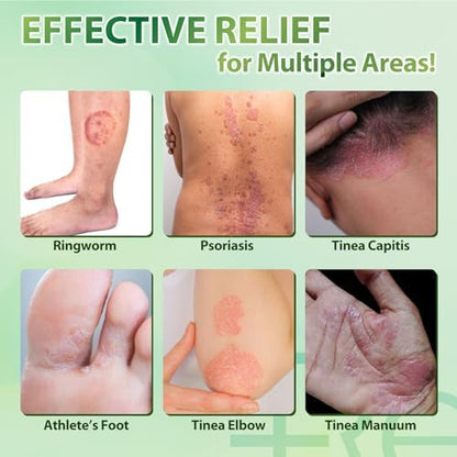 Antifungal skin treatment for men and women showing the natural botanical components.