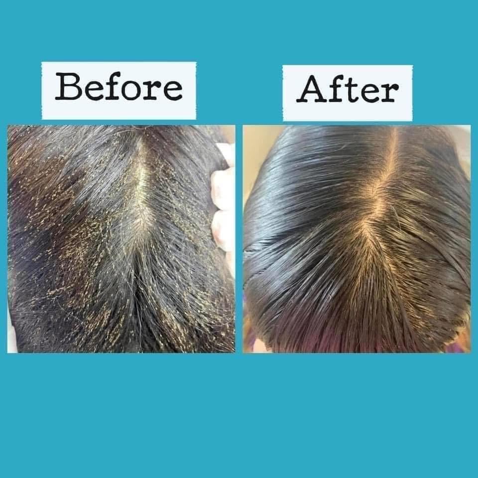 Side view of the complete 3-step lice treatment and prevention system.
