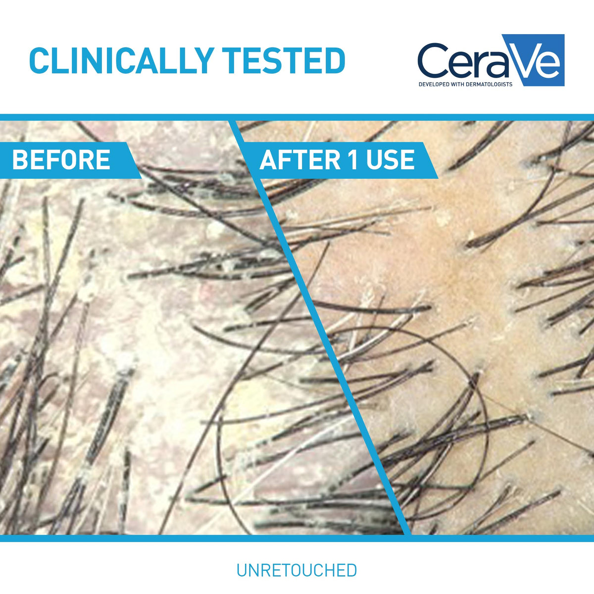 Clinically tested - unretouched scalp before and after one use of the CeraVe anti-dandruff system