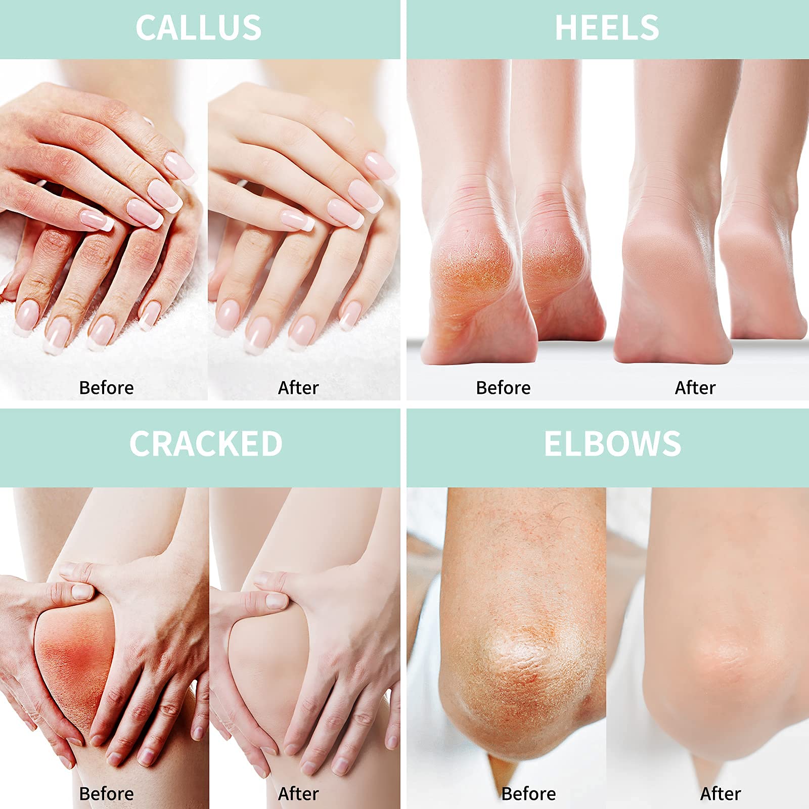 Authentic USA imported Grocerism packaging emphasizing forty percent urea callus remover benefits