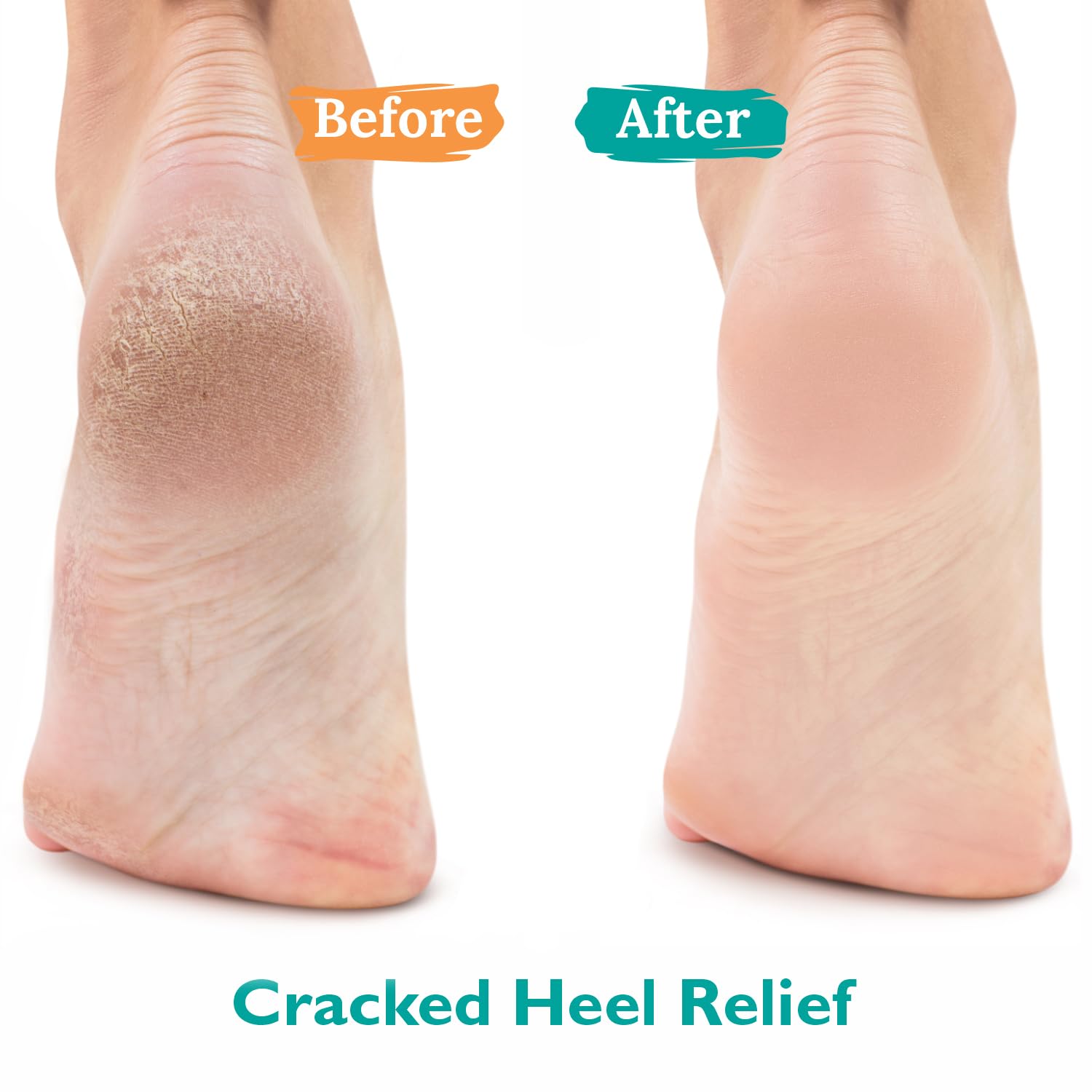 Maximum strength 42 percent urea foot gel for cracking heels and calluses.