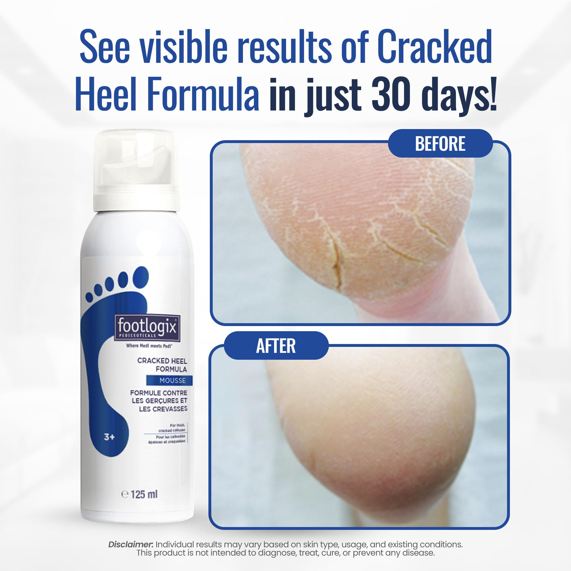 Footlogix Dermal Infusion Technology mousse canister for dry skin hydration