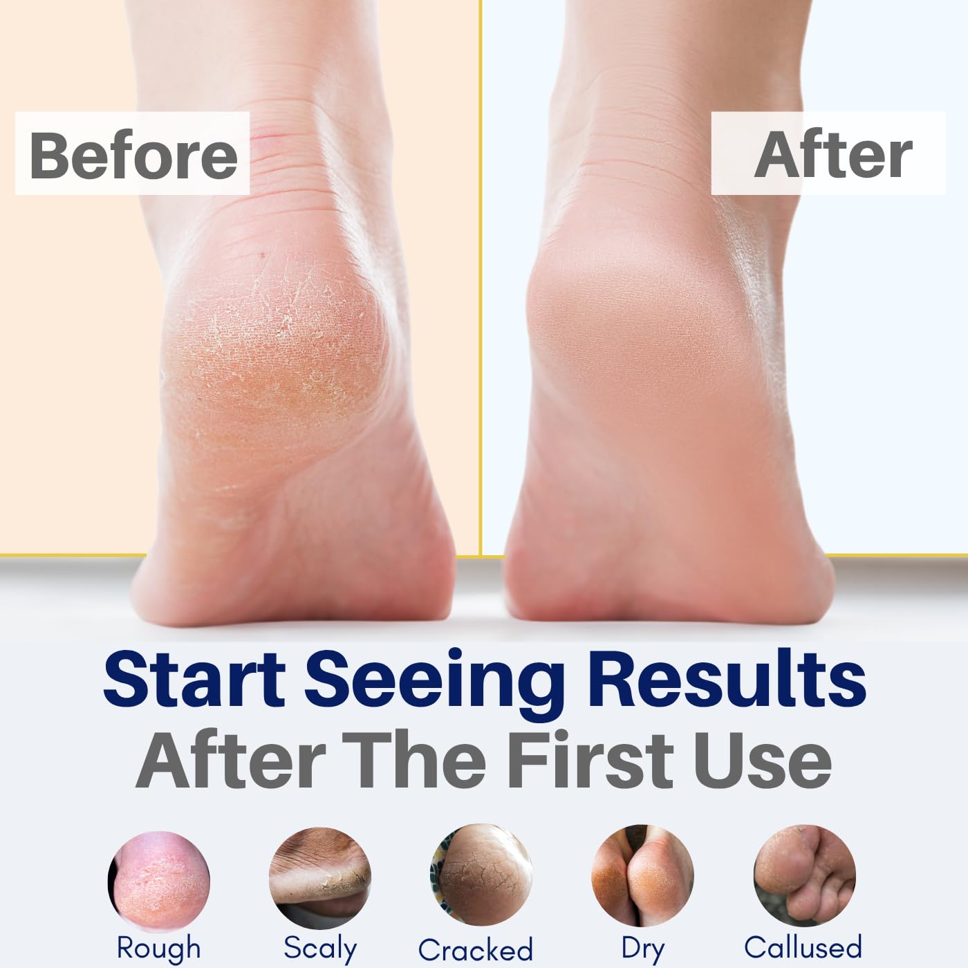 Organic peppermint and tea tree foot balm for antifungal treatment and callus softening