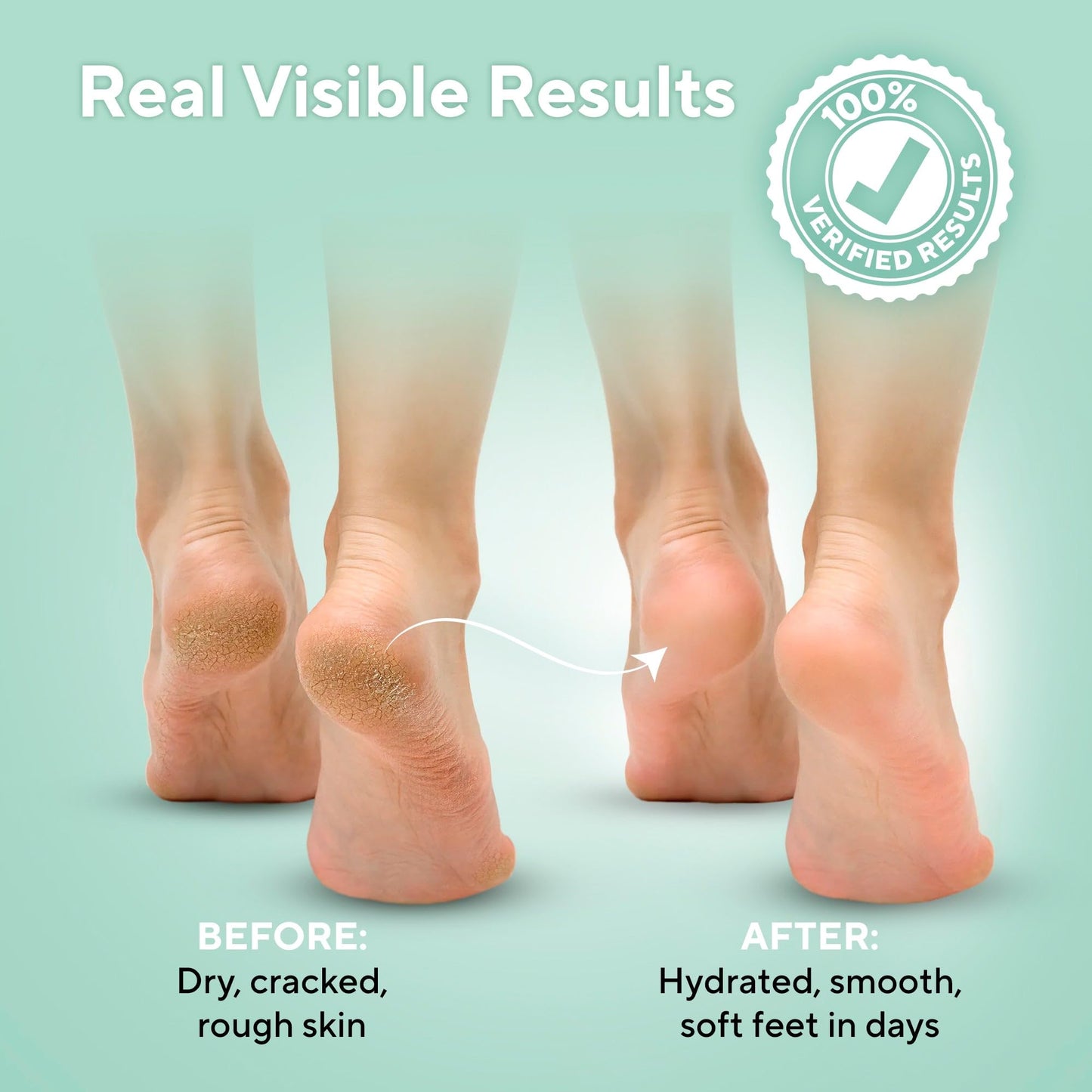 Lavinso rough skin repair cream for treating calluses and dry cracked heels