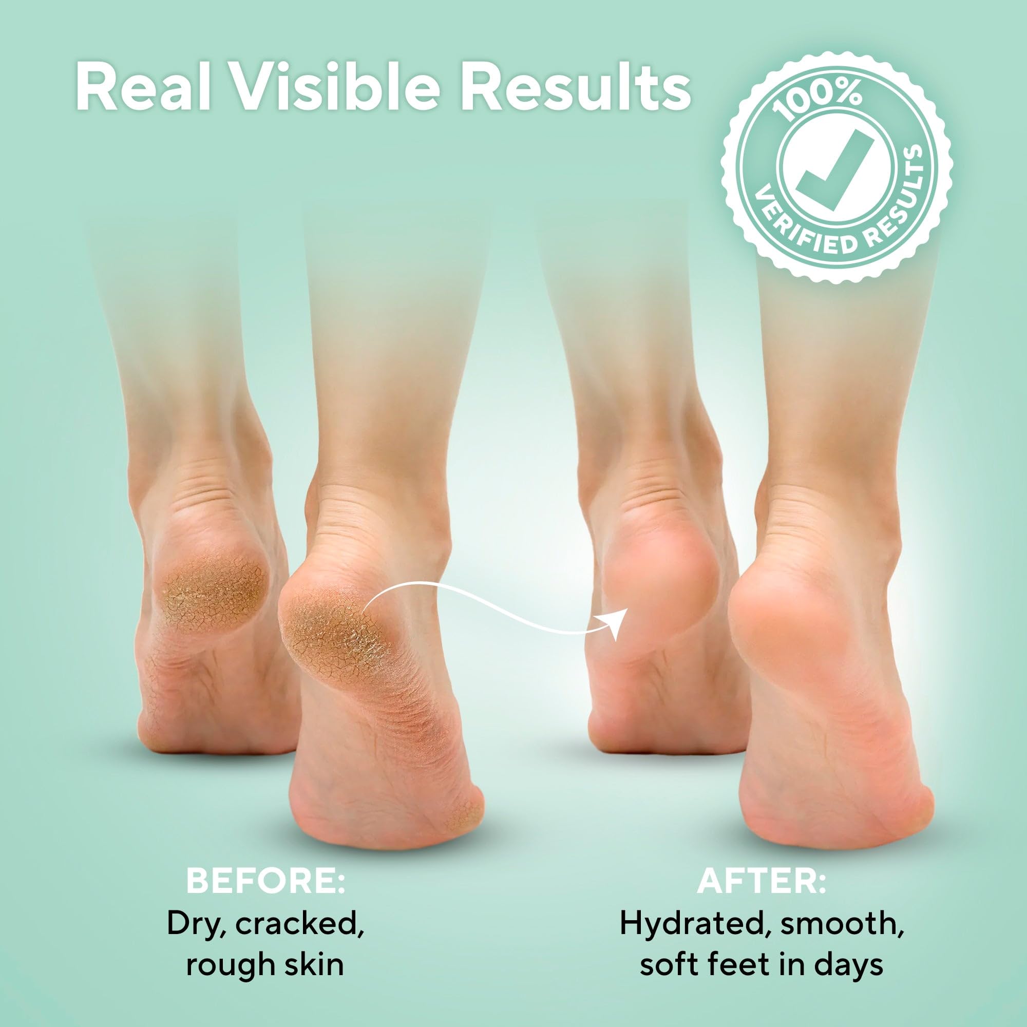 Lavinso rough skin repair cream for treating calluses and dry cracked heels
