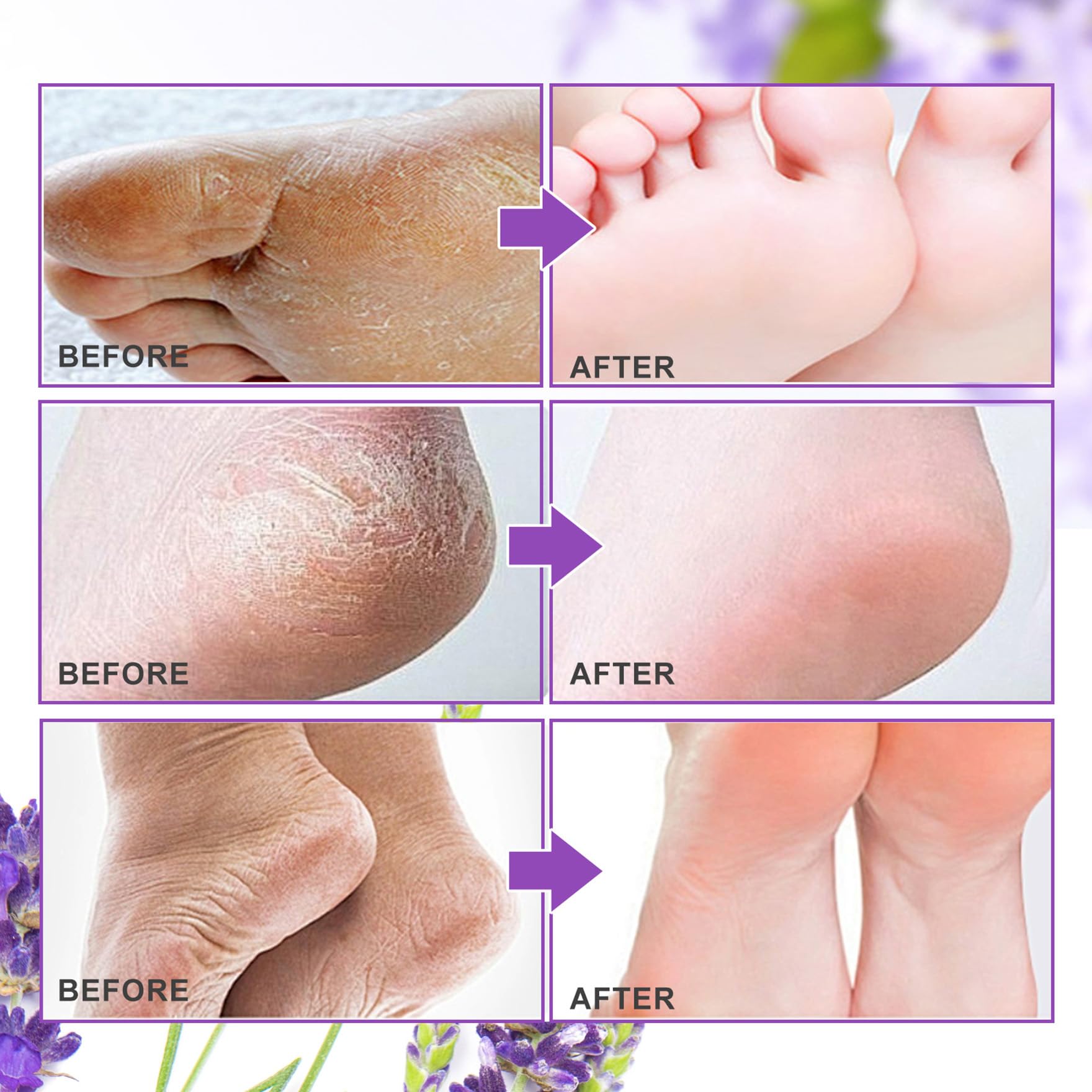 Steps to use Aliver foot peel mask for dead skin removal.