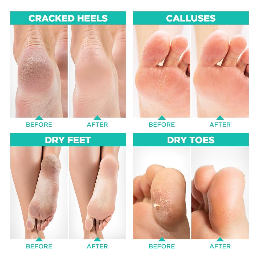 Aloe vera infused foot peeling booties for cracked heel repair