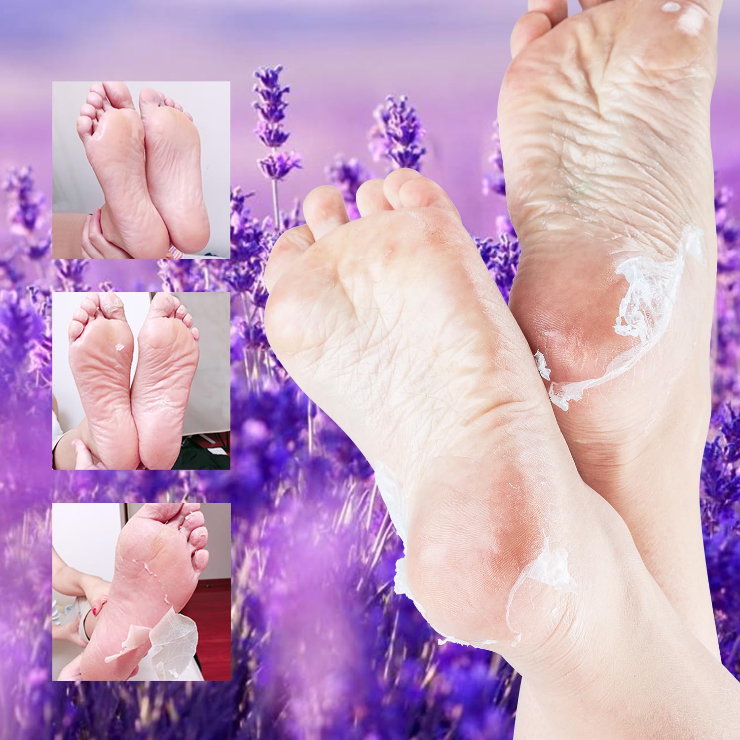 ROUSE foot peeling treatment before and after comparison of cracked heels