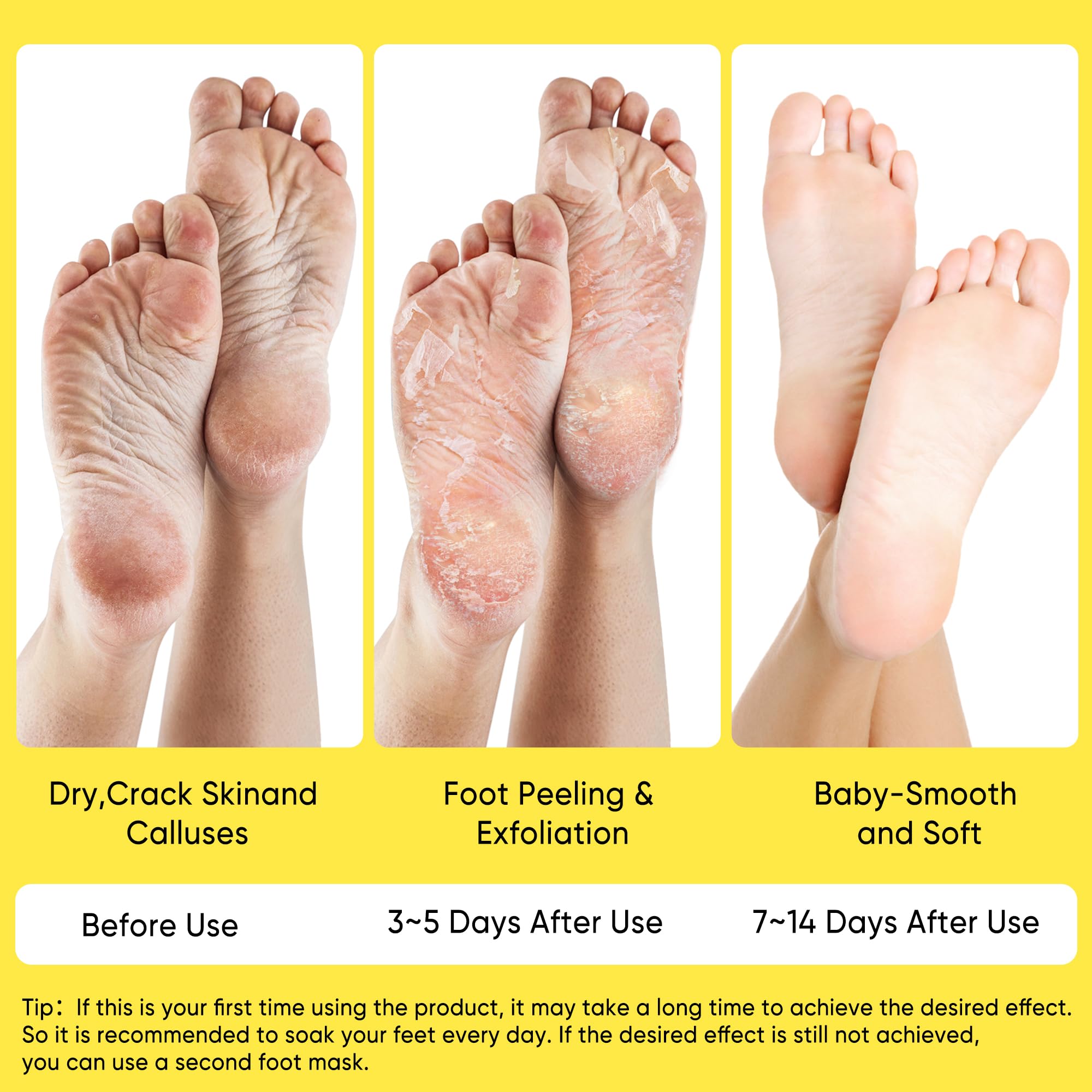 Before and after results of Berlaney foot peel showing soft rejuvenated skin