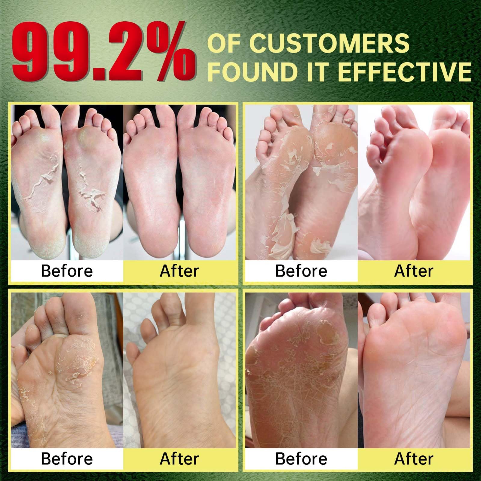Natural exfoliating foot mask booties being worn for heel repair