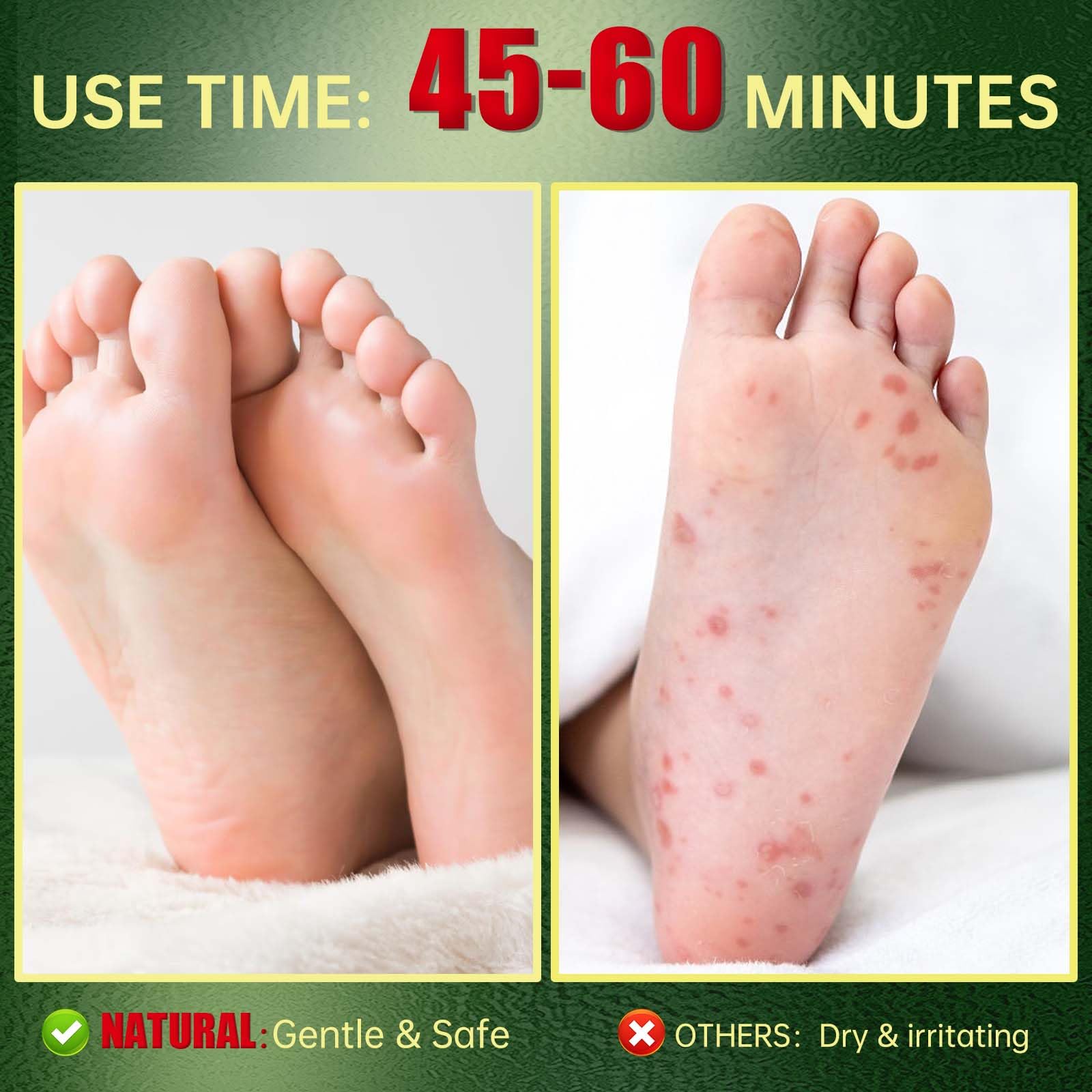 Triple hyaluronic acid foot peeling treatment before and after results
