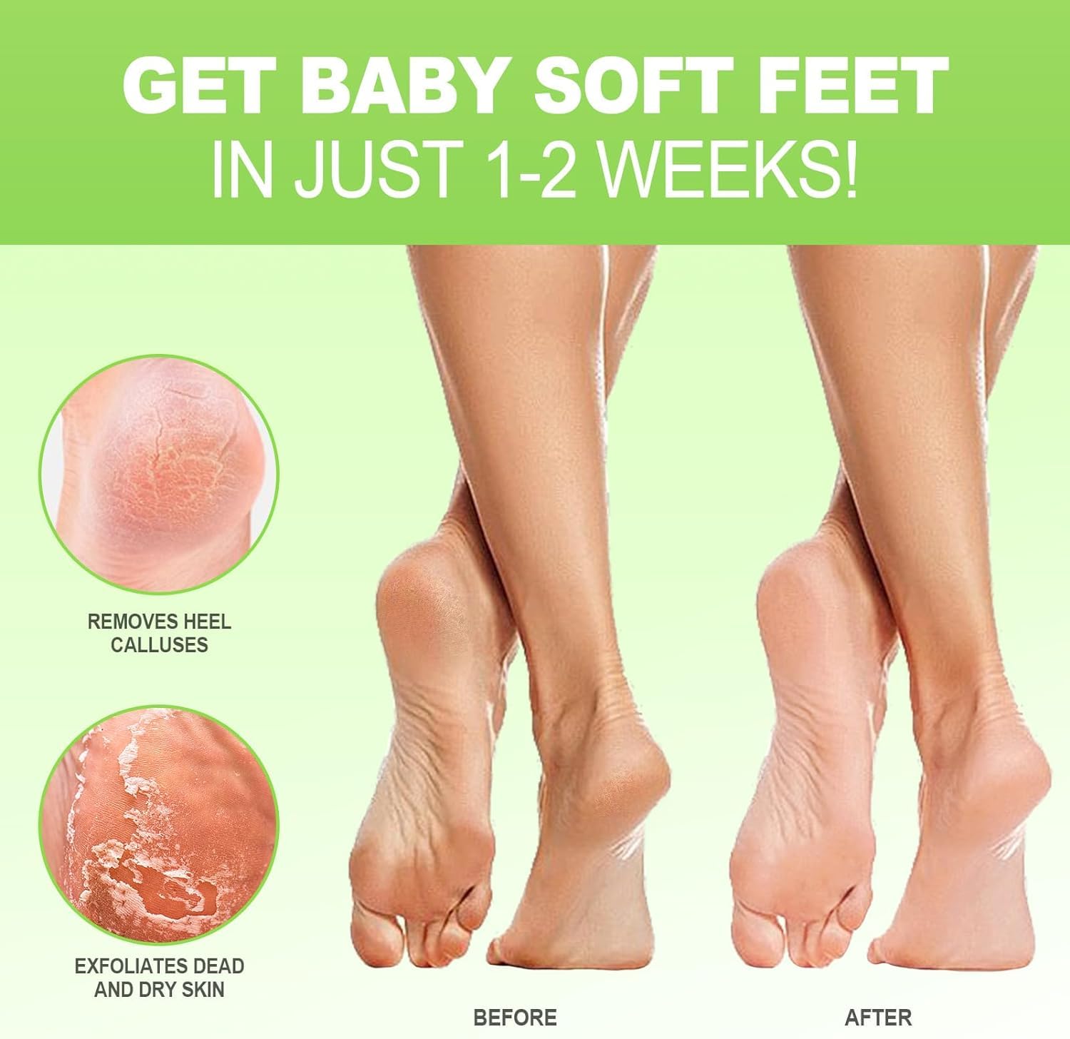 JVR exfoliating foot mask booties being worn for heel repair.